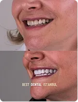 A woman’s smile before and after treatment